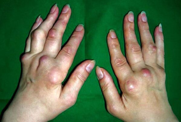 Ruke zahvaćene deformirajućim poliosteoartritisom
