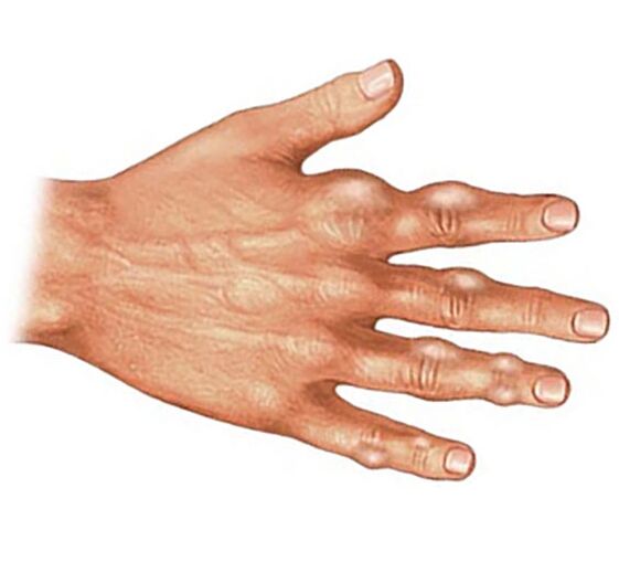 Taloženje kristala mokraćne kiseline u mekim tkivima prstiju kod gihtnog artritisa