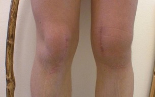 faze razvoja artroze koljena