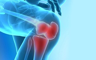 kako se manifestira artroza zgloba koljena