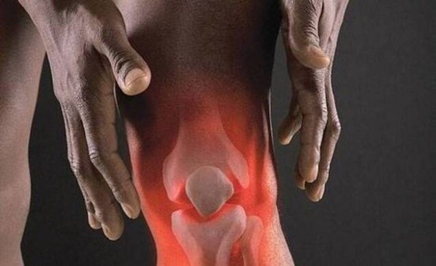 Artroza je popraćena upalnim procesom u zglobu koljena