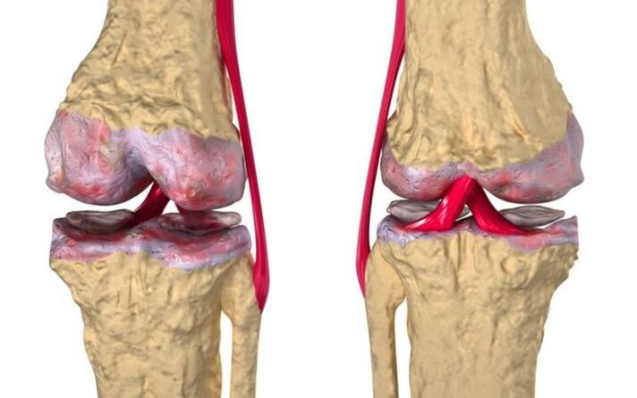 Artroza zgloba koljena